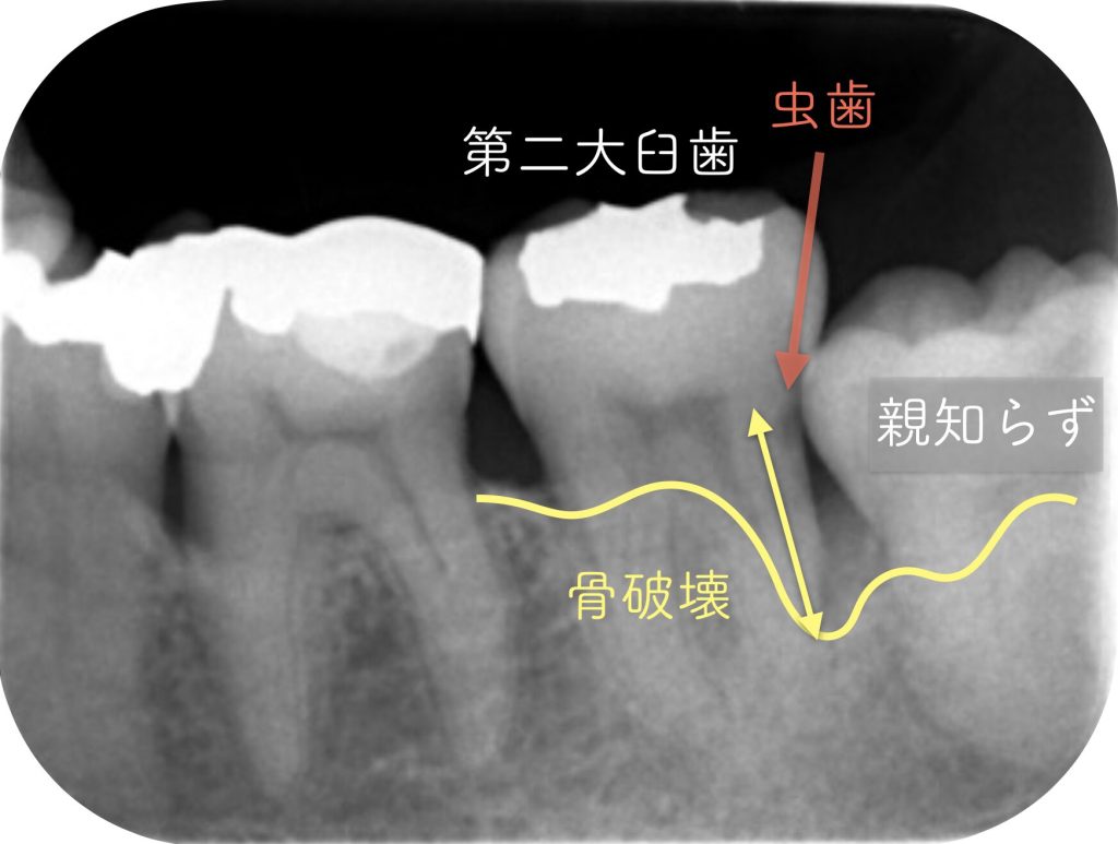親知らずの炎症により第二大臼歯周囲で骨吸収が進行しているレントゲン画像
