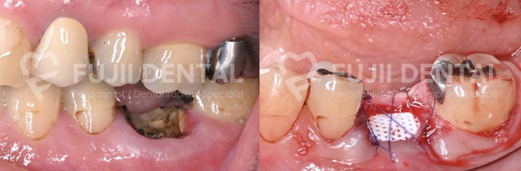 抜歯後に頬側骨の吸収を抑える目的で行ったリッジプリザベーション処置の治療過程