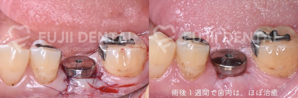 インプラント1回法において、埋入手術と同時にヒーリングアバットメントを装着し、歯肉を切開せずに治癒を促す方法