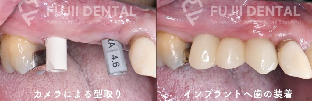 2回法インプラント治療において、歯肉を再度開きインプラントを露出した後、人工の歯を装着するまでの治療過程