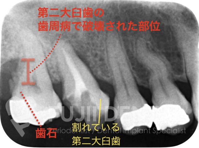 下関市のインプラント症例:初診時の重度歯周病と奥歯の破折を示すレントゲン