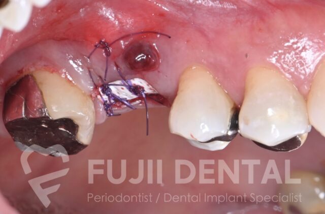 下関での低侵襲インプラント治療:頬側骨の吸収に対し、dPTFE メンブレンを使用し上皮の陥入を排除したARP